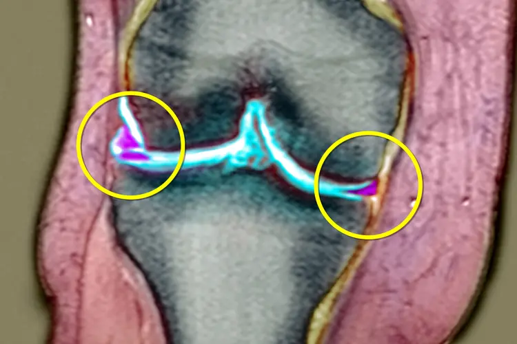 Anatomie du ménisque